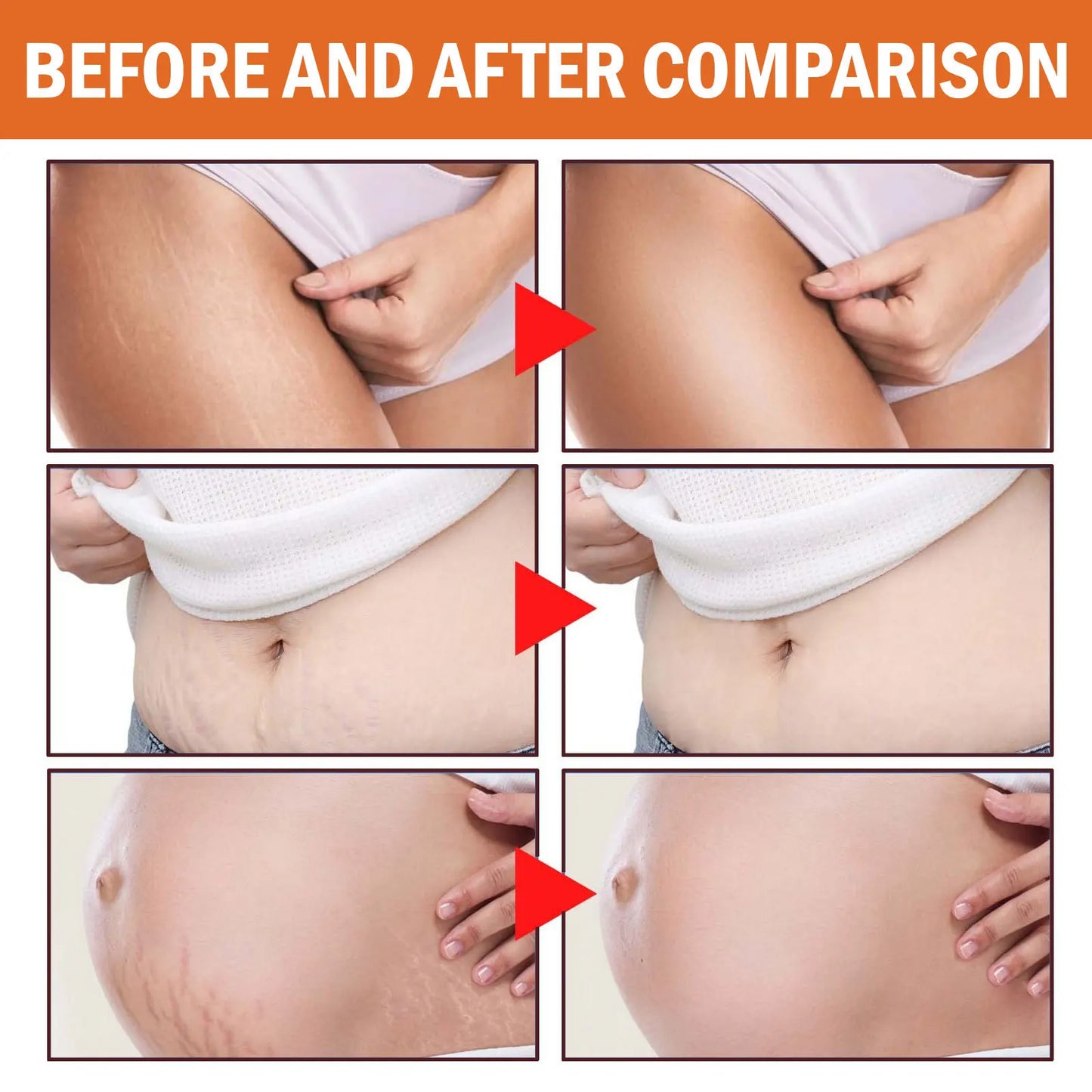 Portable Stretch Mark Removal Cream – Scar & Skin Smoothing Care