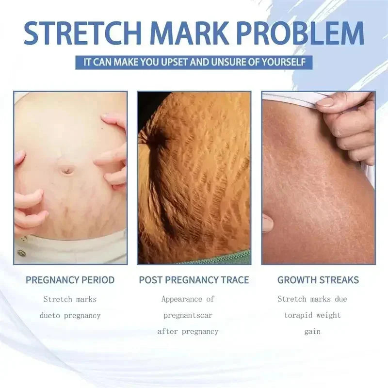 Stretch Mark & Firming Body Cream – Repair & Anti-Aging Care